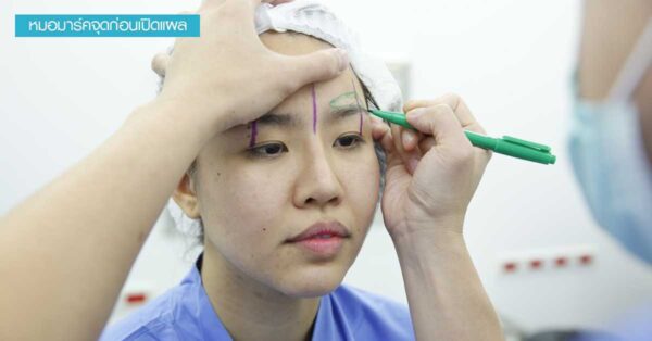 รีวิวตาหางหงส์ ตาหางหงส์ Black Swan Eyes Surgery™ ยกหางตา ตาเฉี่ยว