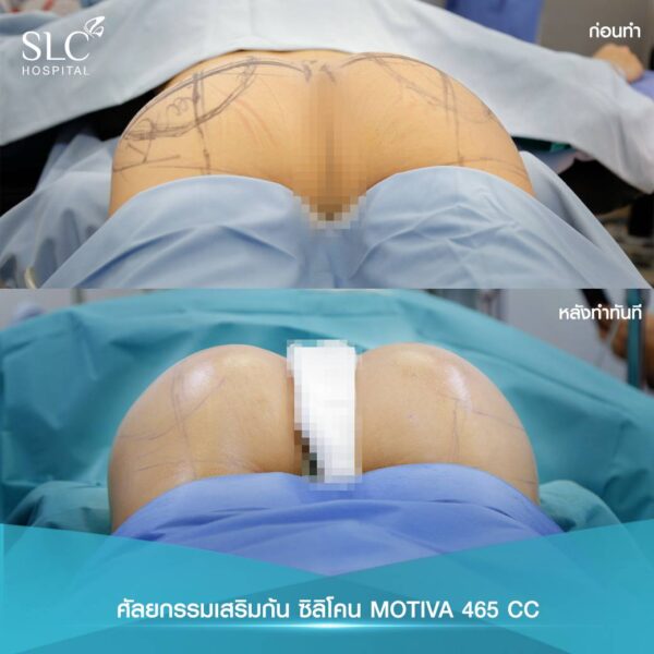 ศัลยกรรมเสริมก้น เสริมก้น เสริมสะโพก ก้นเด้ง Buttock Augmentation