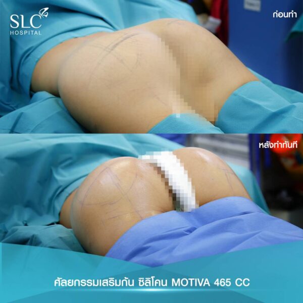 ศัลยกรรมเสริมก้น เสริมก้น เสริมสะโพก ก้นเด้ง Buttock Augmentation