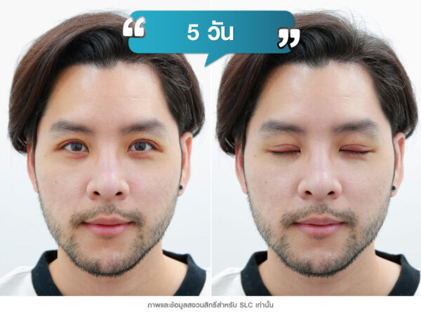ทอม อิศรา ทำศัลยกรรม ทอมRoom39 แก้ตาลึก แก้ตาเศร้า หนังตาตก รีวิวทำตาผู้ชาย ดาราทำตา