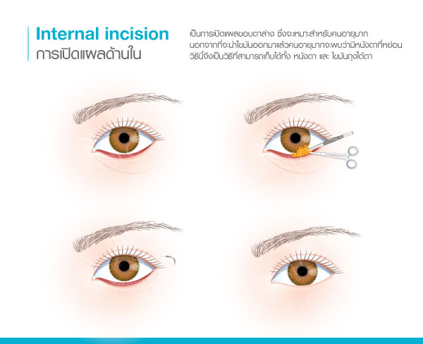 ศัลยกรรมตัดถุงใต้ตา ลดถุงใต้ตา ศัลยกรรมหนังตาล่าง ถุงใต้ตาหย่อน จัดเรียงไขมันใต้ตา