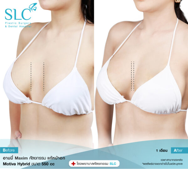 เสริมหน้าอก Breast Augmentation ทำหน้าอก รีวิวเสริมหน้าอก ศัลยกรรมเสริมหน้าอก ทำนม ทำหน้าอกที่ไหนดี เสริมหน้าอกราคา ทำนมหมอไหน เสริมหน้าอกหมอ